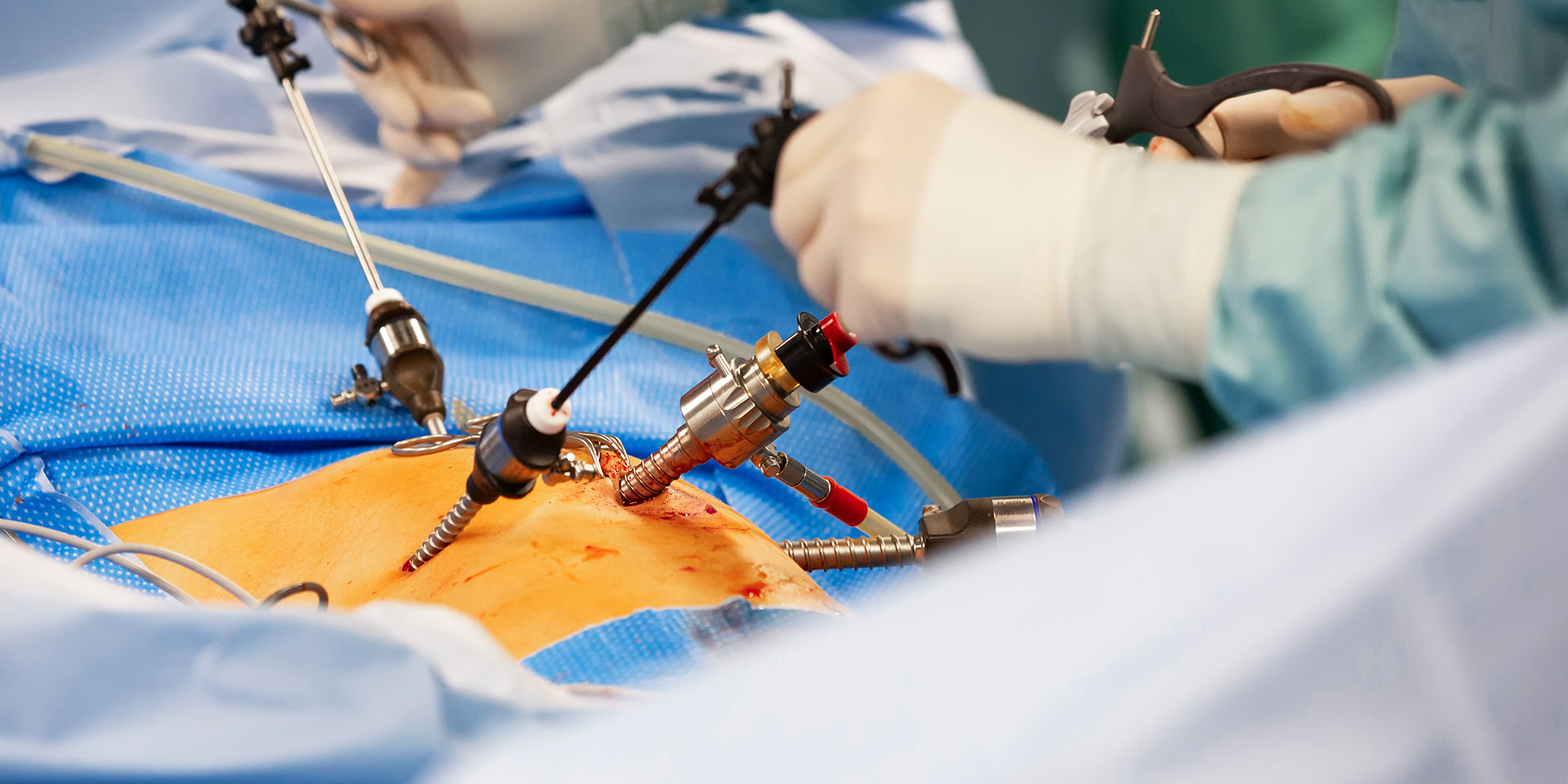Detail-Darstellung einer Operation – Chirurg und OP-Team führen einen minimal-invasiven Eingriff durch.